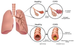 Understanding COPD – Lung Flare Care