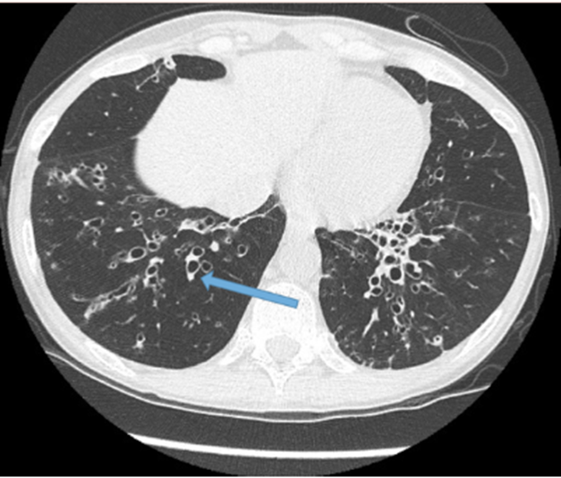 Figure x. Elderly male patient with COPD and bronchiectasis. Arrow pointing to signet ring sign 